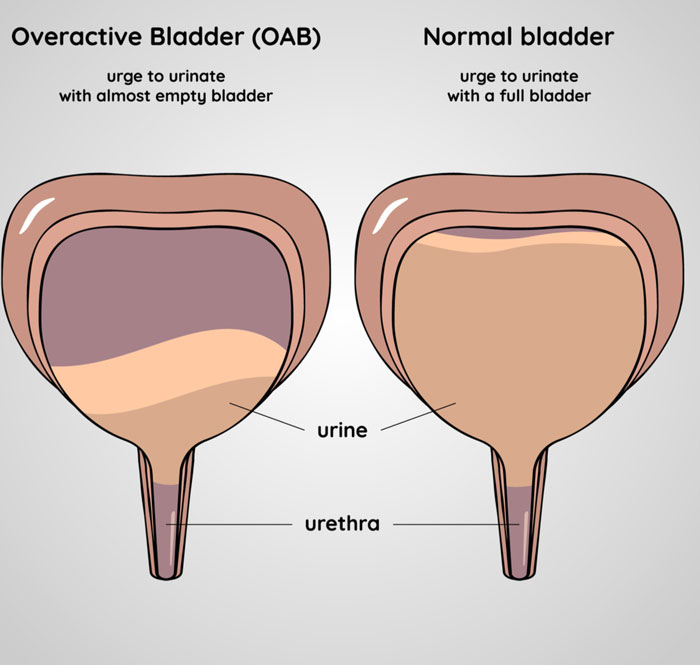Overactive vs Normal bladder
